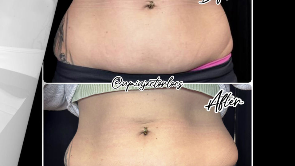 Liquid Lipo Before and Afters